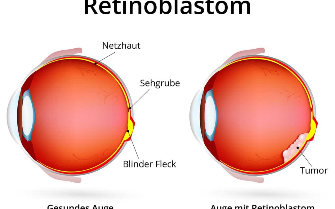 Gemeinsam stark: Institut W. Trester und KAKS für Kinder mit Retinoblastom